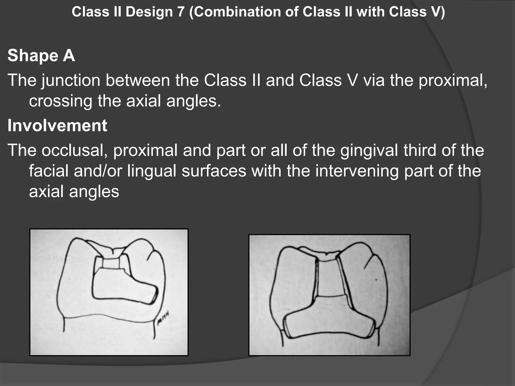 Class II Design 7 (Combination of Class II with Class V) 
Shape A 
The junction between the Class II and Class V via the proximal, 
crossing the axial angles. 
Involvement 
The occlusal, proximal and part or all of the gingival third of the 
facial and/or lingual surfaces with the intervening part of the 
axial angles 
 