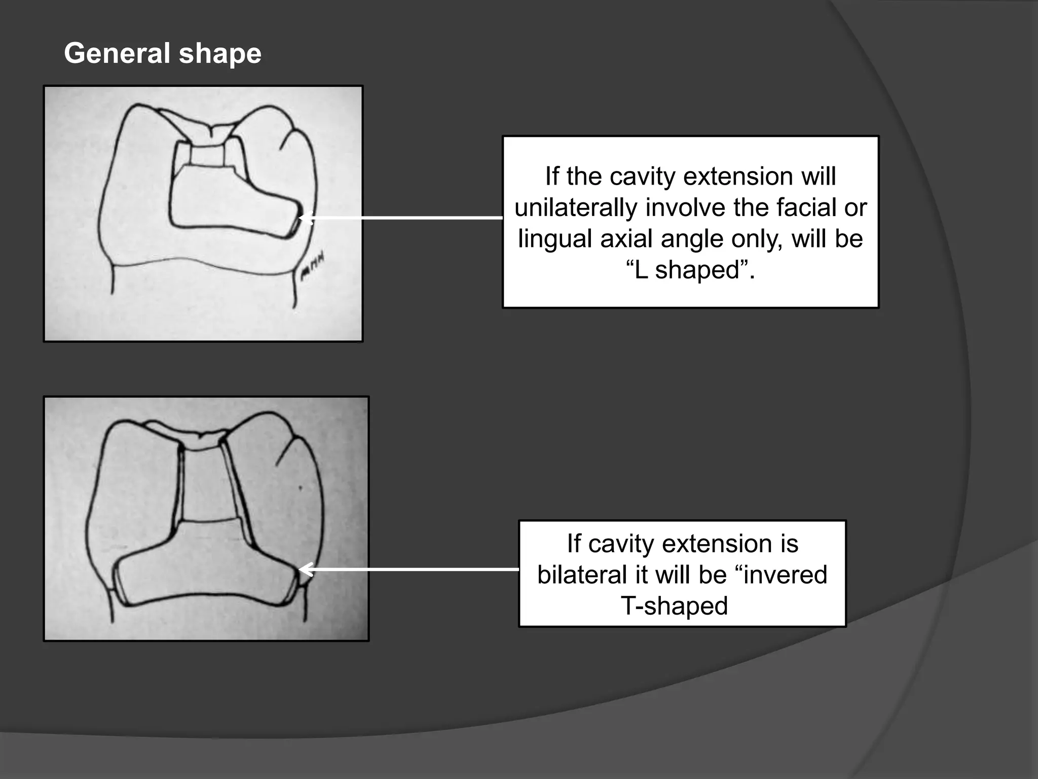 If the cavity extension will 
unilaterally involve the facial or 
lingual axial angle only, will be 
“L shaped”. 
If cavity extension is 
bilateral it will be “invered 
T-shaped”. 
General shape 
 