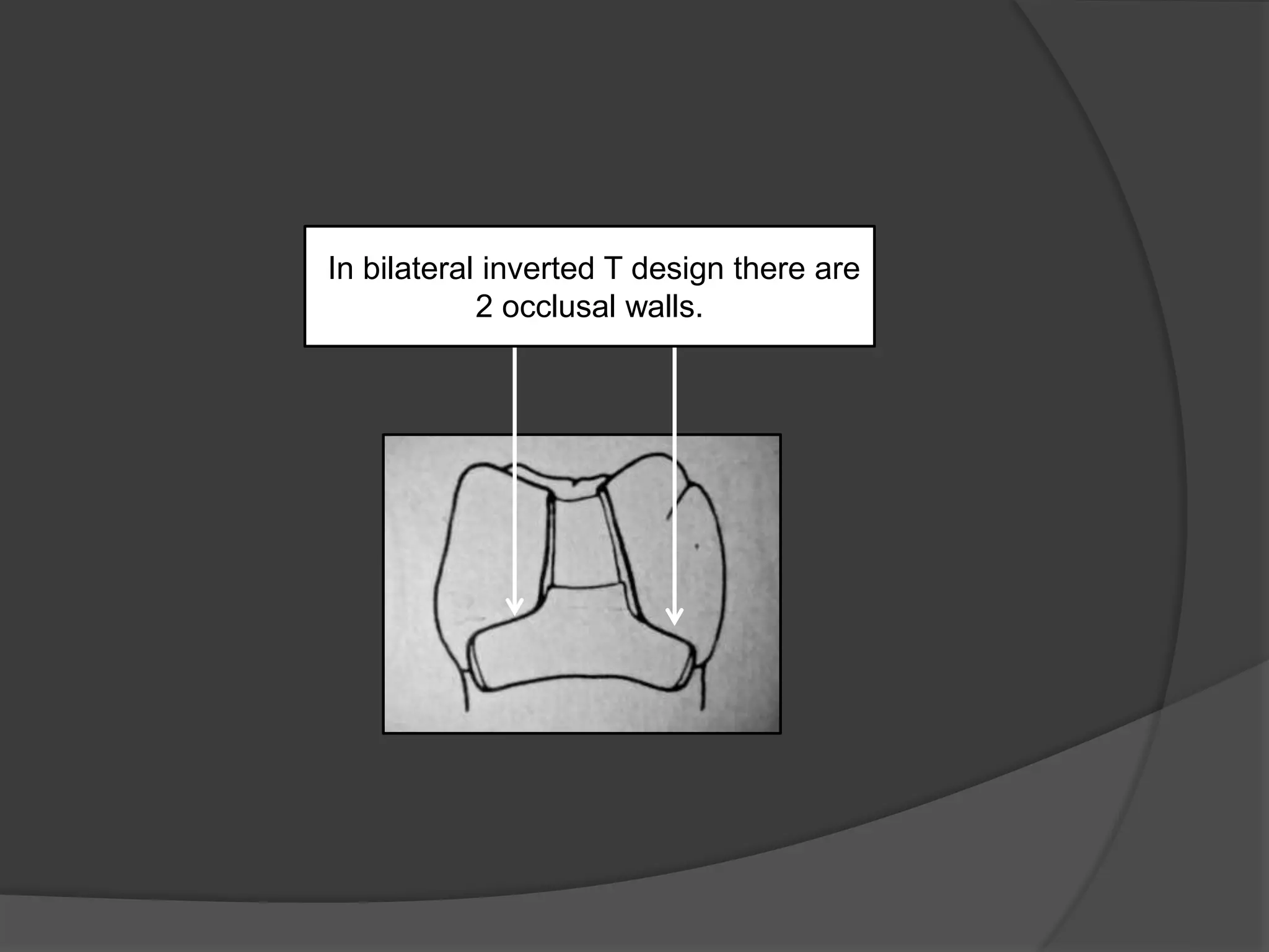 In bilateral inverted T design there are 
2 occlusal walls. 
 