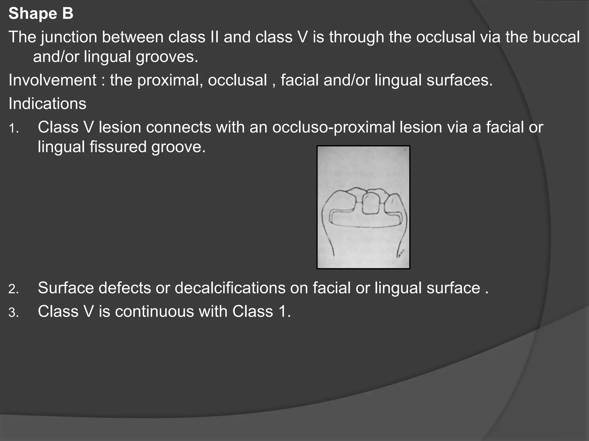 Shape B 
The junction between class II and class V is through the occlusal via the buccal 
and/or lingual grooves. 
Involvement : the proximal, occlusal , facial and/or lingual surfaces. 
Indications 
1. Class V lesion connects with an occluso-proximal lesion via a facial or 
lingual fissured groove. 
2. Surface defects or decalcifications on facial or lingual surface . 
3. Class V is continuous with Class 1. 
 