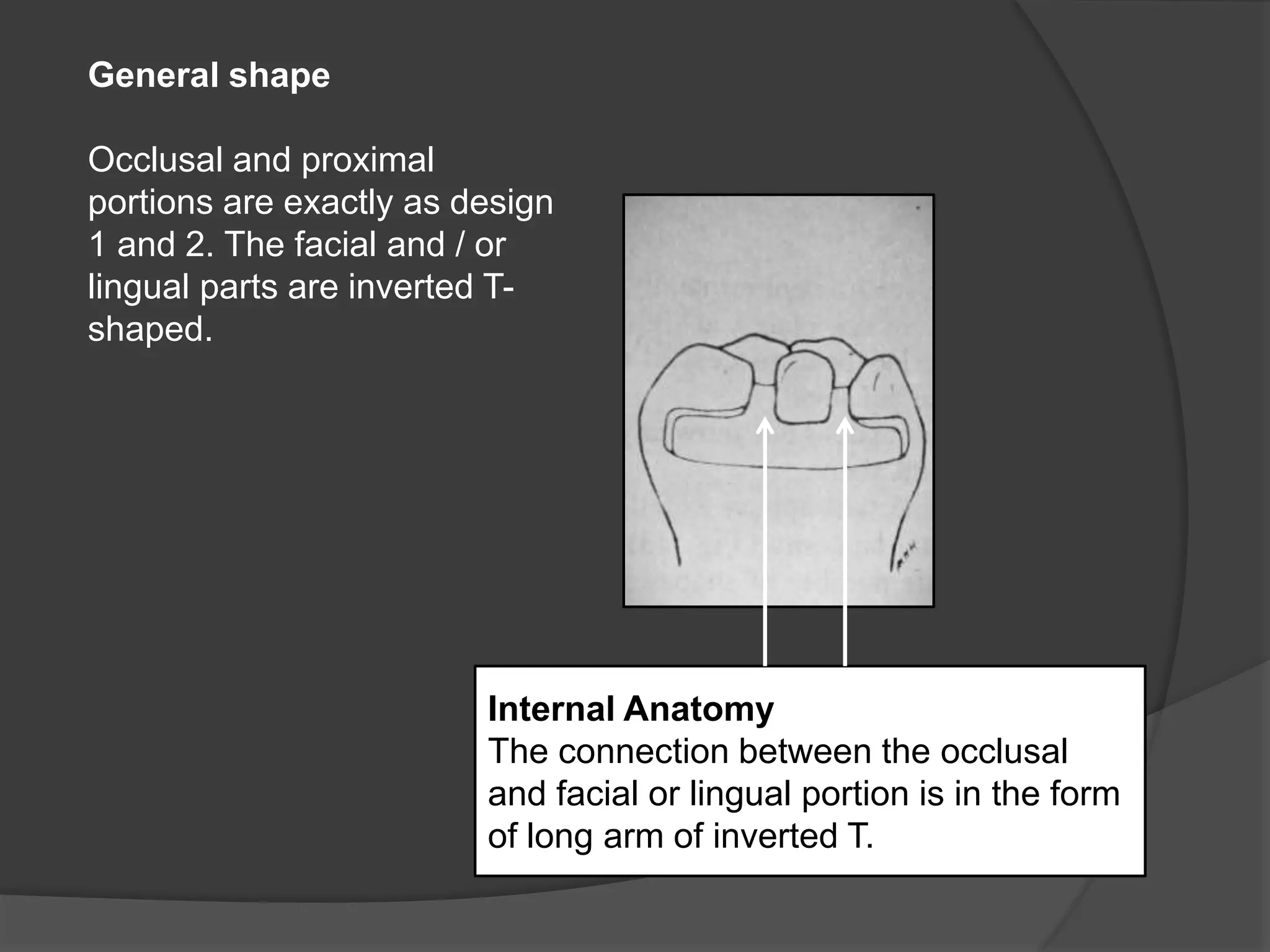 General shape 
Occlusal and proximal 
portions are exactly as design 
1 and 2. The facial and / or 
lingual parts are inverted T-shaped. 
Internal Anatomy 
The connection between the occlusal 
and facial or lingual portion is in the form 
of long arm of inverted T. 
 