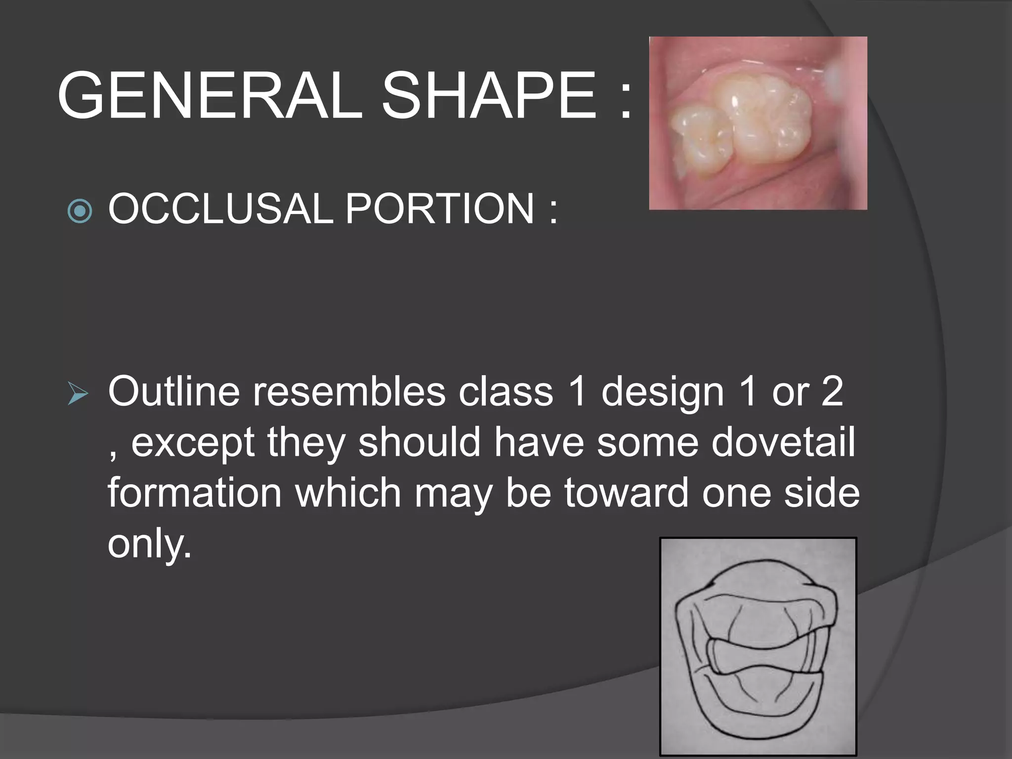 GENERAL SHAPE : 
 OCCLUSAL PORTION : 
 Outline resembles class 1 design 1 or 2 
, except they should have some dovetail 
formation which may be toward one side 
only. 
 