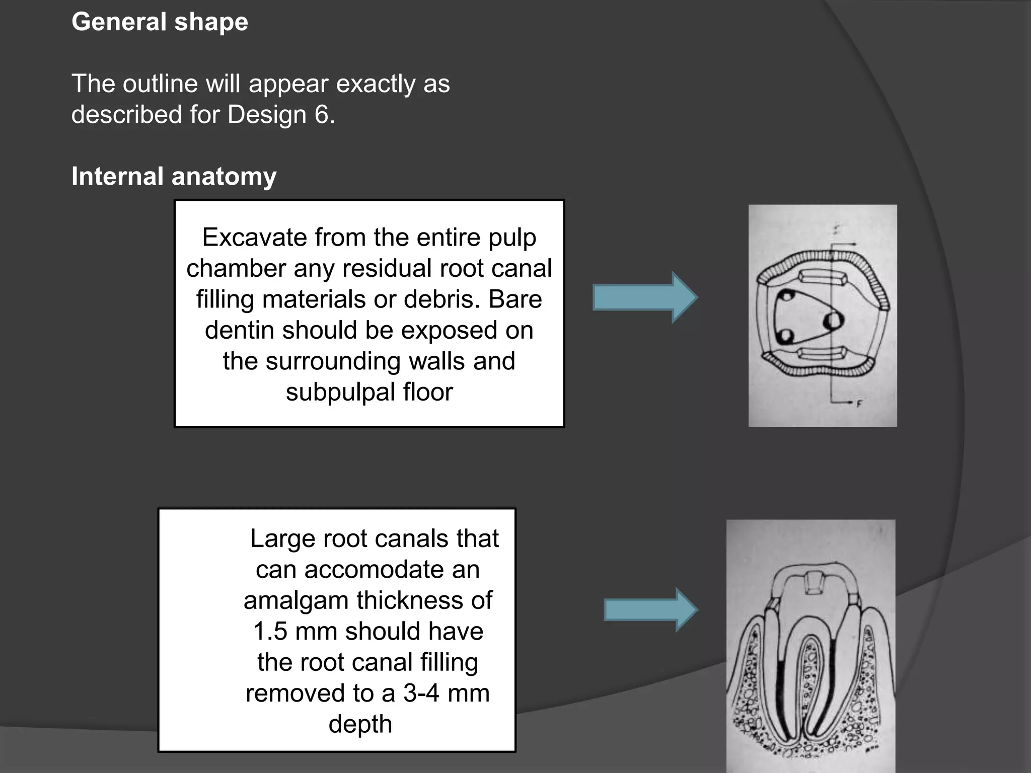 Excavate from the entire pulp 
chamber any residual root canal 
filling materials or debris. Bare 
dentin should be exposed on 
the surrounding walls and 
subpulpal floor 
Large root canals that 
can accomodate an 
amalgam thickness of 
1.5 mm should have 
the root canal filling 
removed to a 3-4 mm 
depth . 
General shape 
The outline will appear exactly as 
described for Design 6. 
Internal anatomy 
 