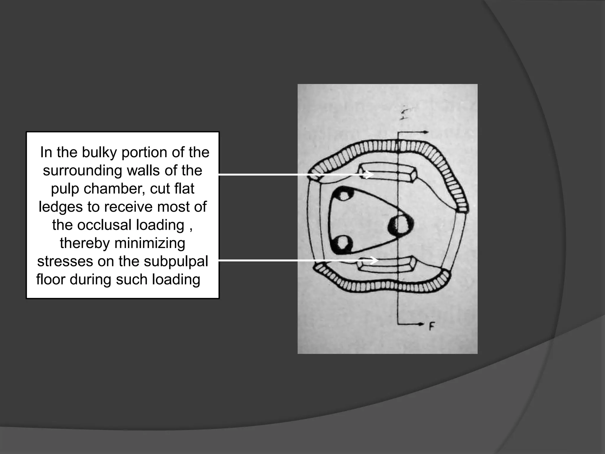 In the bulky portion of the 
surrounding walls of the 
pulp chamber, cut flat 
ledges to receive most of 
the occlusal loading , 
thereby minimizing 
stresses on the subpulpal 
floor during such loading . 
 