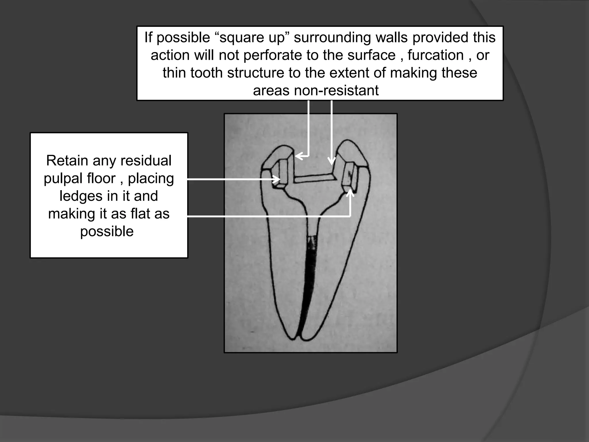 If possible “square up” surrounding walls provided this 
action will not perforate to the surface , furcation , or 
thin tooth structure to the extent of making these 
areas non-resistant . 
Retain any residual 
pulpal floor , placing 
ledges in it and 
making it as flat as 
possible. 
 
