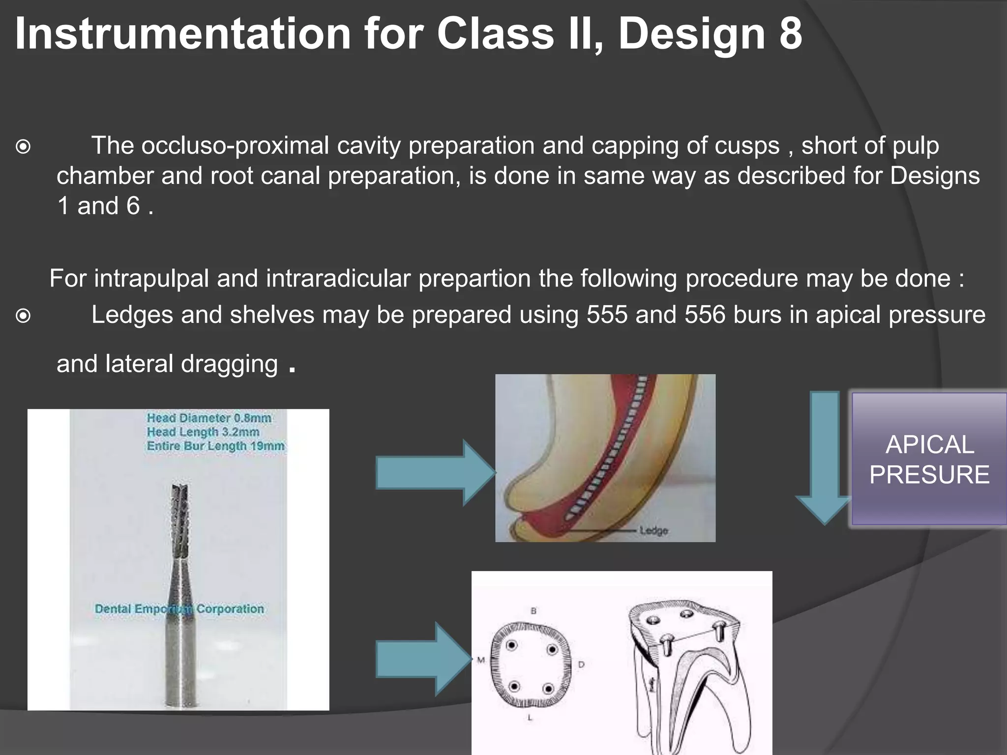 Instrumentation for Class II, Design 8 
 The occluso-proximal cavity preparation and capping of cusps , short of pulp 
chamber and root canal preparation, is done in same way as described for Designs 
1 and 6 . 
For intrapulpal and intraradicular prepartion the following procedure may be done : 
 Ledges and shelves may be prepared using 555 and 556 burs in apical pressure 
and lateral dragging . 
APICAL 
PRESURE 
 
