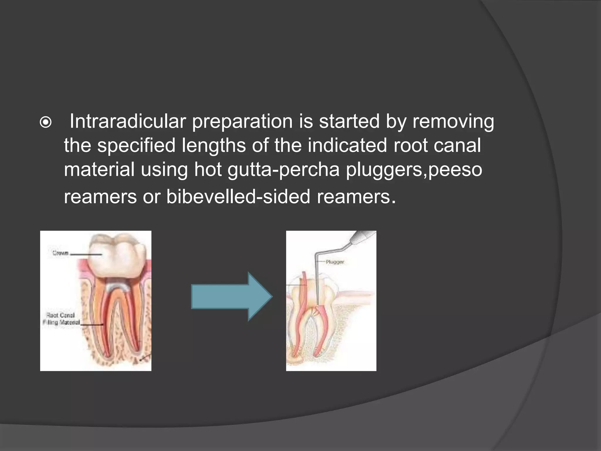  Intraradicular preparation is started by removing 
the specified lengths of the indicated root canal 
material using hot gutta-percha pluggers,peeso 
reamers or bibevelled-sided reamers. 
 