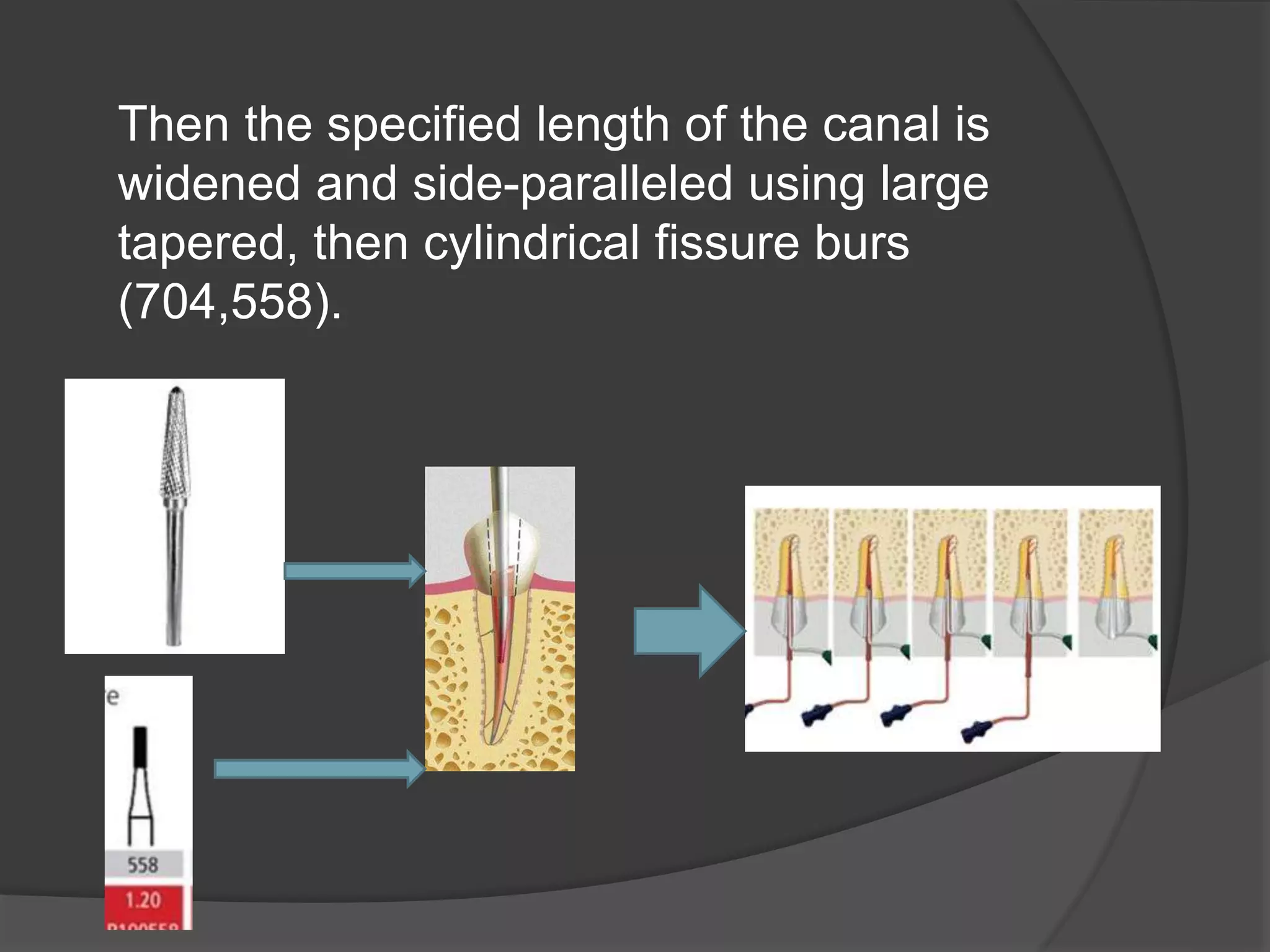 Then the specified length of the canal is 
widened and side-paralleled using large 
tapered, then cylindrical fissure burs 
(704,558). 
 