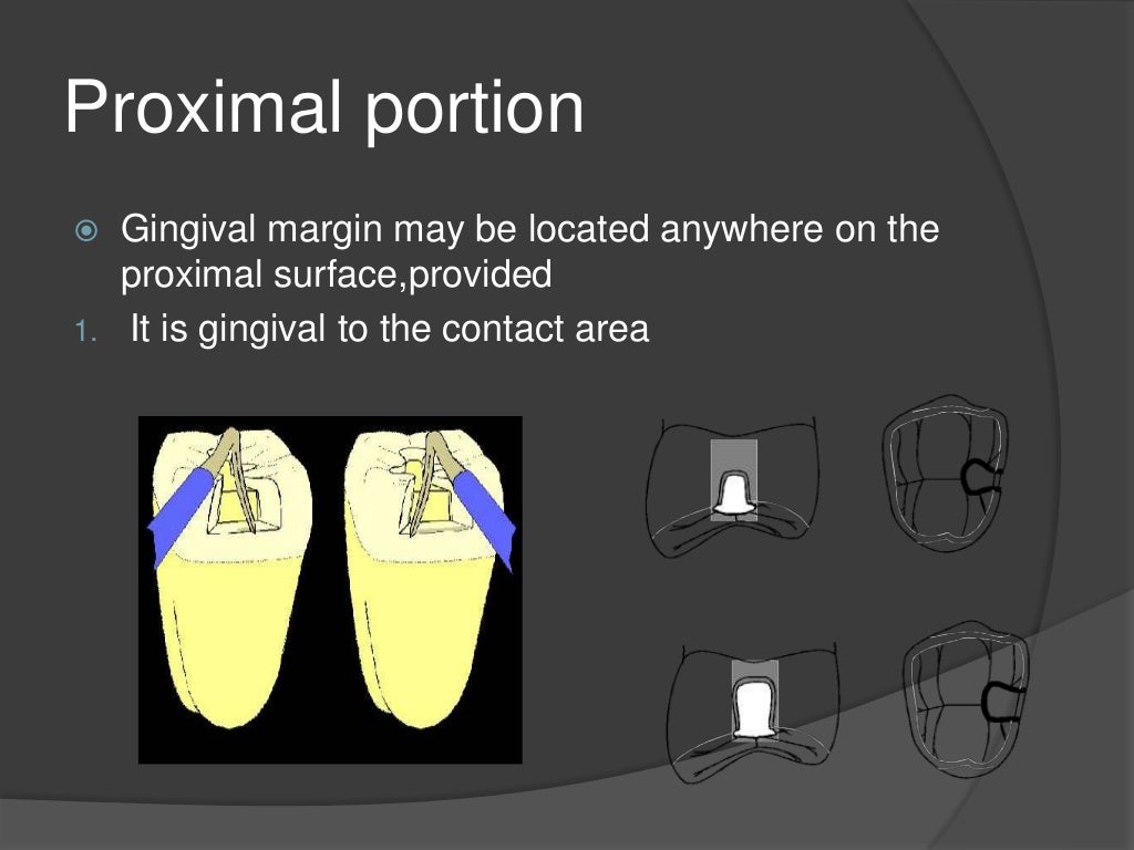 Modifications of Class 2 Cavity preparations
