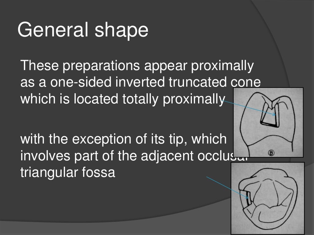 Modifications of Class 2 Cavity preparations