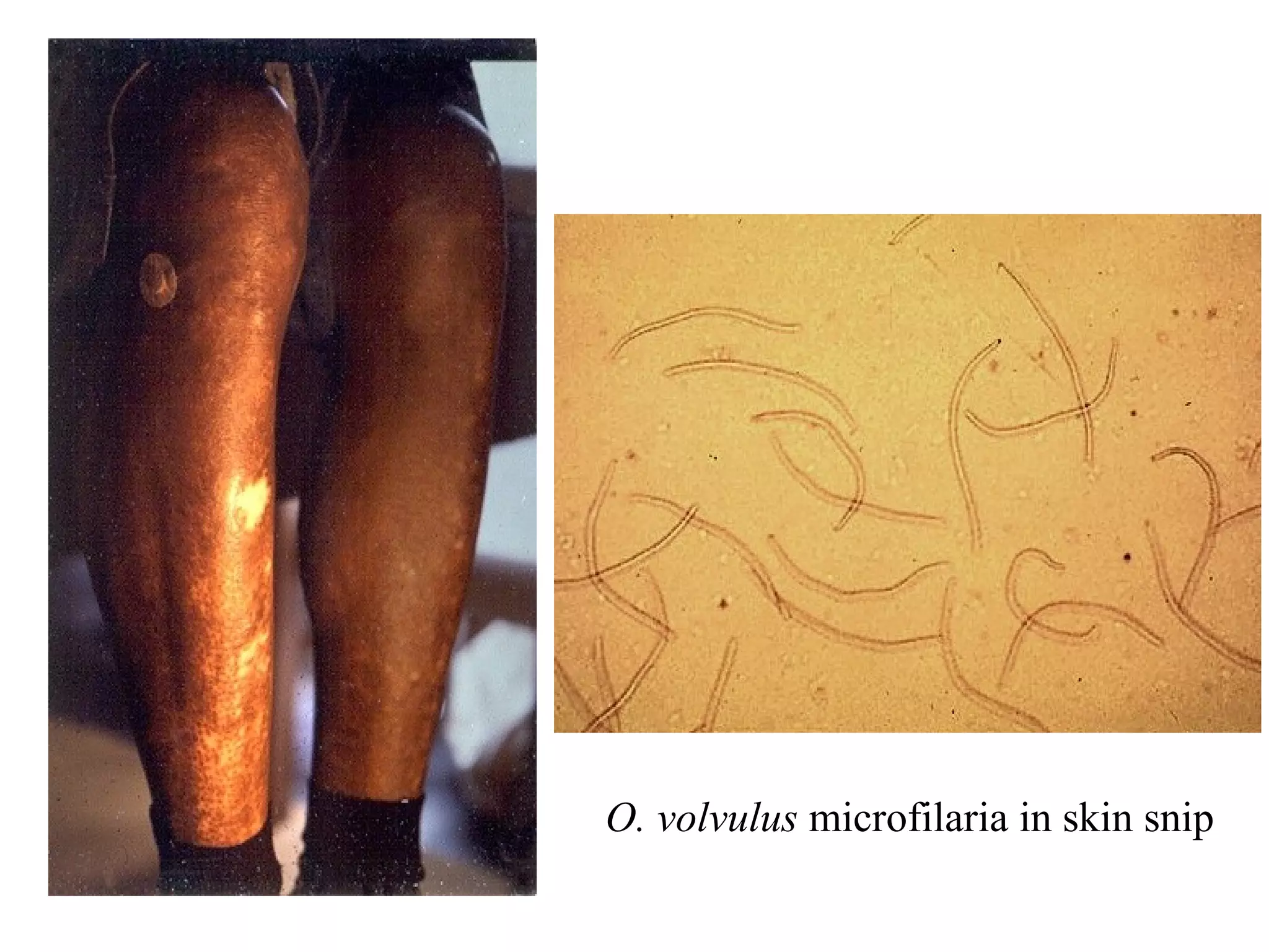 O. volvulus microfilaria in skin snip
 