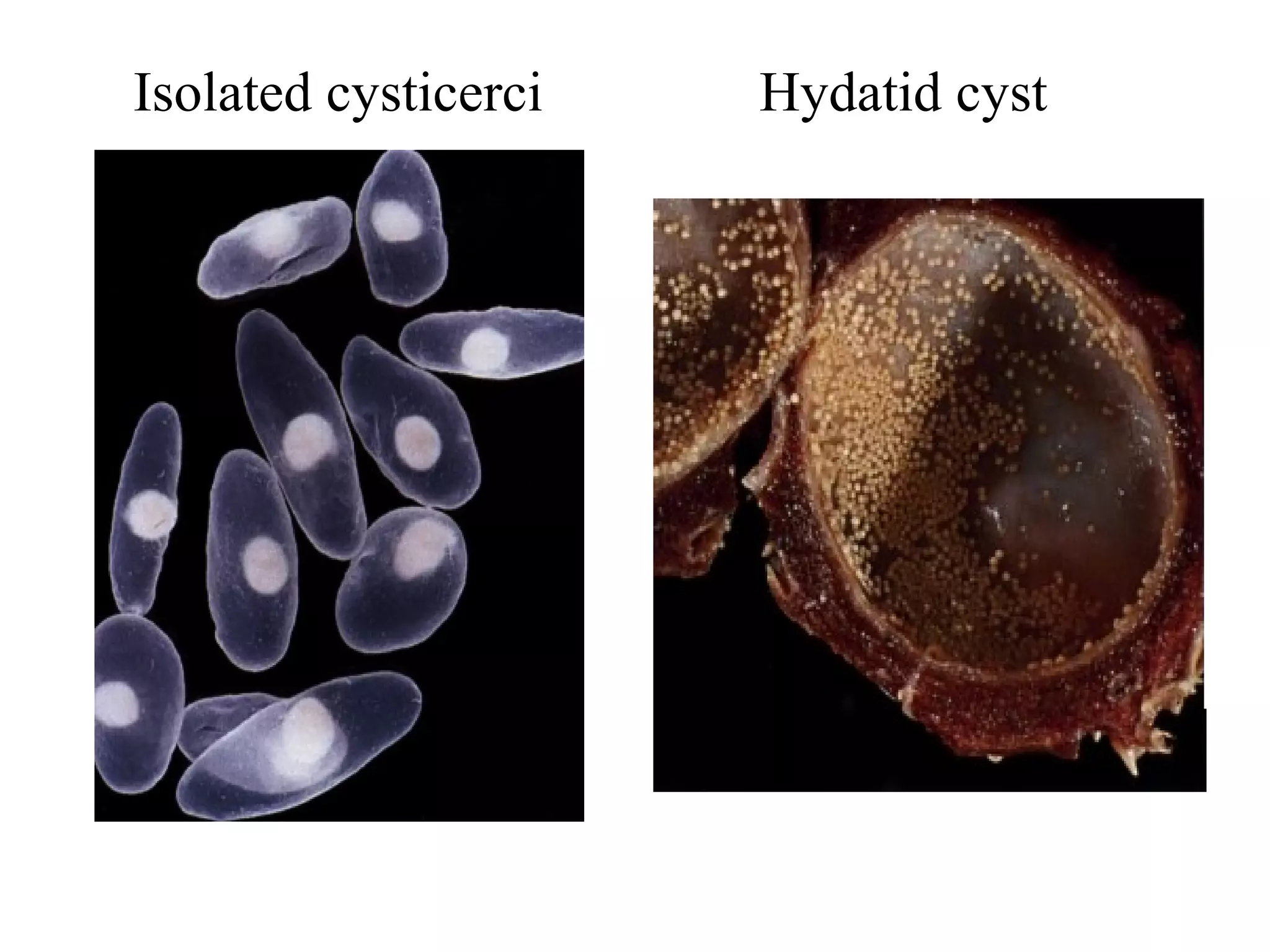 Isolated cysticerci Hydatid cyst
 