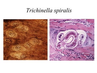 Trichinella spiralis
 
