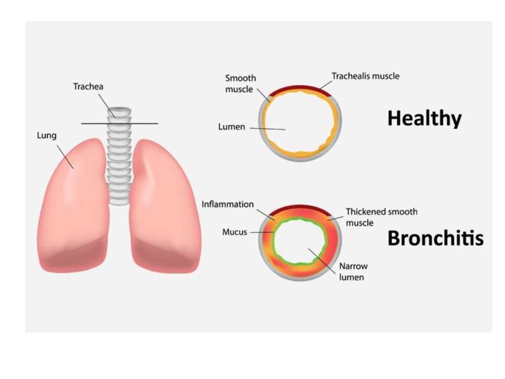 obstructive bronchitis