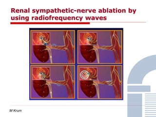 Renal sympathetic-nerve ablation by
using radiofrequency waves
M Krum
 