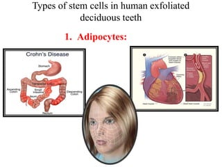 Types of stem cells in human exfoliated 
deciduous teeth 
1. Adipocytes: 
 