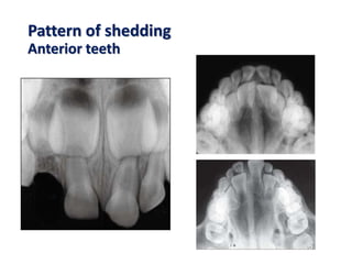Pattern of shedding
Anterior teeth
 