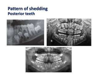 Pattern of shedding
Posterior teeth
 