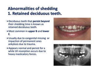 Abnormalities of shedding
1. Retained deciduous teeth.
Deciduous teeth that persist beyond
their shedding time is known as
retained deciduous teeth.
Most common in upper B and lower
E.
Usually due to congenital missing or
impaction of permanent ones
ankylosis due to trauma.
Appears normal and persist for a
while till resorption occurs due to
heavy masticatory forces.
 