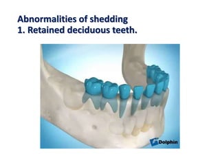 Abnormalities of shedding
1. Retained deciduous teeth.
 