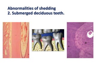 Abnormalities of shedding
2. Submerged deciduous teeth.
 