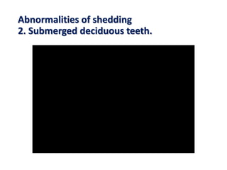 Abnormalities of shedding
2. Submerged deciduous teeth.
 
