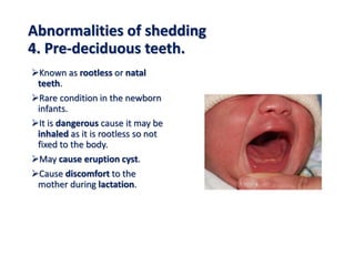 Abnormalities of shedding
4. Pre-deciduous teeth.
Known as rootless or natal
teeth.
Rare condition in the newborn
infants.
It is dangerous cause it may be
inhaled as it is rootless so not
fixed to the body.
May cause eruption cyst.
Cause discomfort to the
mother during lactation.
 