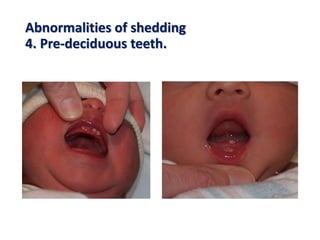 Abnormalities of shedding
4. Pre-deciduous teeth.
 
