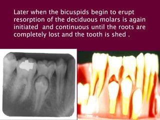 Later when the bicuspids begin to erupt 
resorption of the deciduous molars is again 
initiated and continuous until the roots are 
completely lost and the tooth is shed . 
 