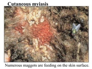 Cutaneous myiasis Numerous maggots are feeding on the skin surface. 