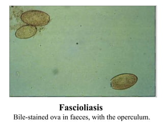 Fascioliasis Bile-stained ova in faeces, with the operculum. 