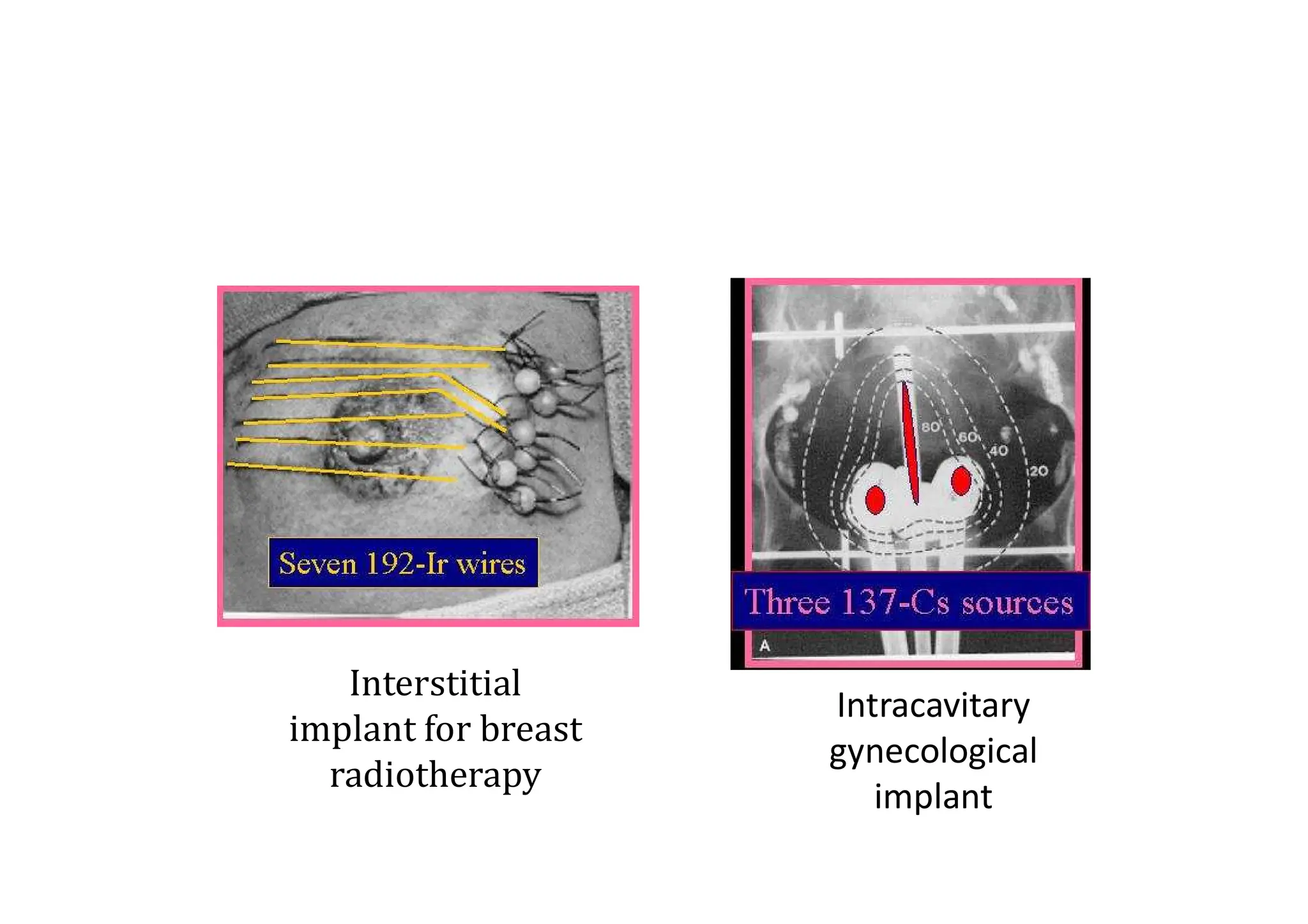 Interstitial Radiotherapy sheet one for radiation technology 1.pdf