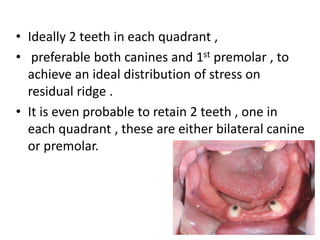 (Overdenture) (1).pdf