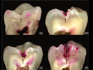 Sheet BDS 2025 Dental Caries.ppt sheettt | PPT