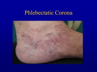 Phlebectatica Management of Incompetence in the Axial Veins | PPTX