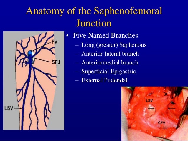 Management of Incompetence in the Axial Veins