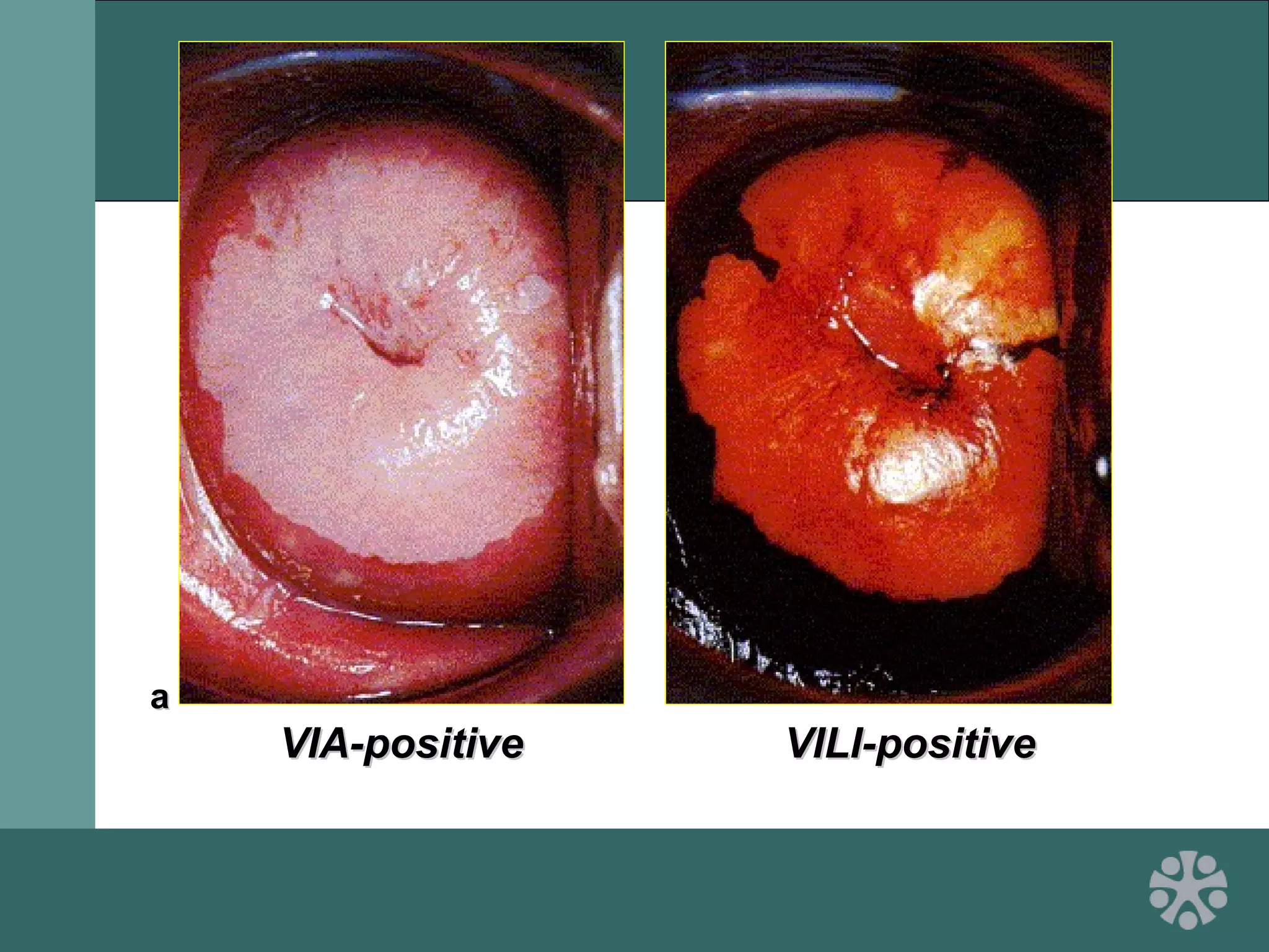 VIA-positiveVIA-positive VILI-positiveVILI-positive
aa
 