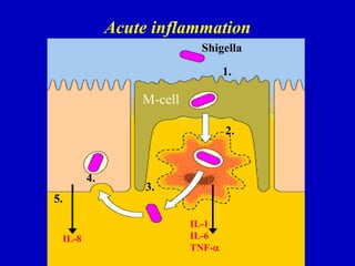 Acute inflammation
Shigella
1.
2.
IL-1
IL-6
TNF-
3.
4.
IL-8
5.
M-cell
 