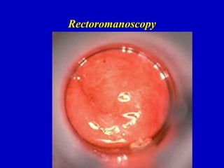 Rectoromanoscopy
 