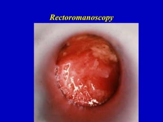 Rectoromanoscopy
 