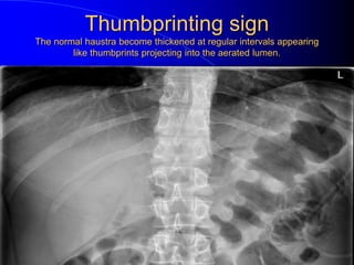 Thumbprinting sign
The normal haustra become thickened at regular intervals appearing
like thumbprints projecting into the aerated lumen.
 