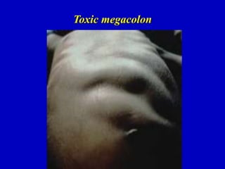 Toxic megacolon
 