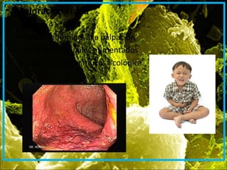 • Exploración Física
– Fiebre 41 °C
– Dolor abdominal a la palpación
– Ruidos intestinales aumentados
– Hiperemia de la mucosa colónica
 