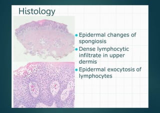 Histology
⚫ Epidermal changes of
spongiosis
⚫ Dense lymphocytic
infiltrate in upper
dermis
⚫ Epidermal exocytosis of
lymphocytes
 