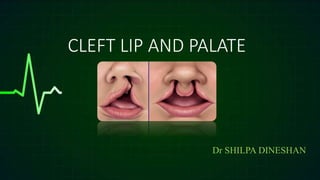 CLEFT LIP AND PALATE
Dr SHILPA DINESHAN
 