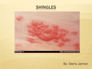 Shingles By: Sierra Jarmon 