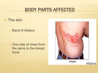 Shingles In Chest Shingles | PPTX
