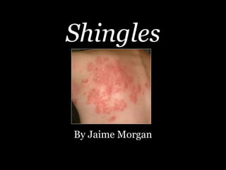 Shingles


By Jaime Morgan
 