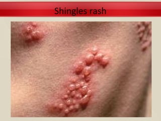 Shingles rash
 