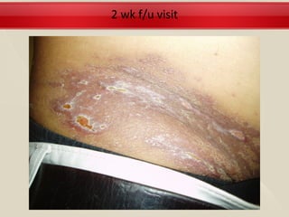 2 wk f/u visit
 